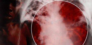 भारत में अनुमान से 3 गुणा ज्यादा टीबी रोगी