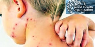 अब खसरा मुक्त देश बनाने का लक्ष्य