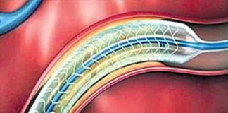 ‘दिल’ के इलाज में जरूरी स्टेंट दो फीसदी महंगा