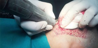 हेयर रिमूविंग ट्रीटमेंट के मरीज उठा रहे परेशानी