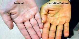 एक साथ 40 स्कूली बच्चों में पीलिया के लक्षण