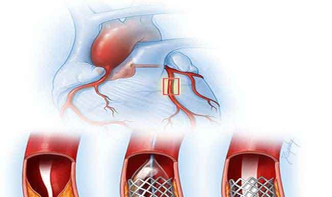 बढ़ सकते हैं स्टेंट के दाम, सरकार और एनपीपीए पर दबाव