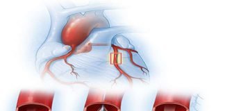 नहीं सस्ते हुए स्टेंट, मरीज की जेब पर अब भी डाका