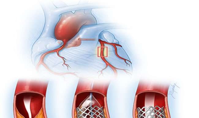 आज से नई कीमत पर मिलेंगे स्टेंट्स