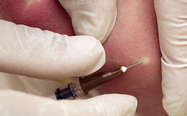 फर्जीवाड़ा : कागजों में ही लगा दिए बीसीजी इंजेक्शन vaccine