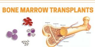 एमवाय में हुआ बोन मैरो ट्रांसप्लांट