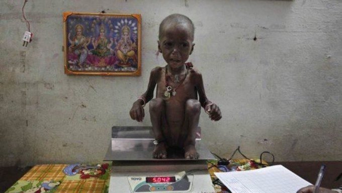 सबसे ज्यादा कुपोषित बच्चे मोदी और राहुल के लोकसभा क्षेत्र में