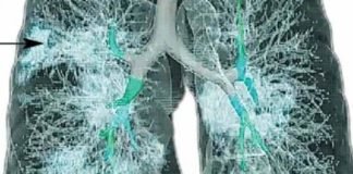 कोरोना से प्रभावित फेफड़े की पहली 3 डी इमेज