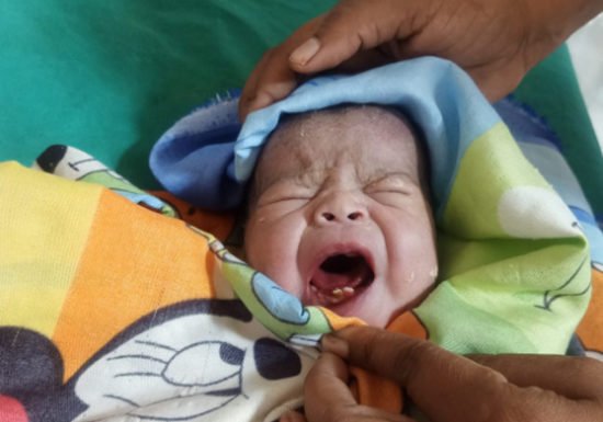 बच्ची ने दो दांत के साथ लिया अस्पताल में जन्म