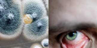 चौकाने वाला खुलासा, न कोरोना न ही डायबिटीज फिर भी हुए ब्लैक फंगसके शिकार, हरियाणा में 143 ऐसे केस