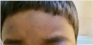 सावधान! ब्लैक फंगस के कहर का शिकार हो रहे बच्चे, इतने बच्चों को गंवानी पड़ी आंख