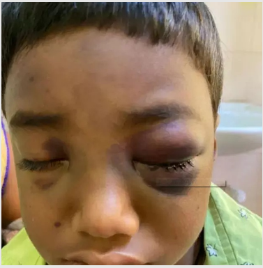 सावधान! ब्लैक फंगस के कहर का शिकार हो रहे बच्चे, इतने बच्चों को गंवानी पड़ी आंख