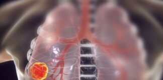 दवा सूंघकर होगा फेफड़े के कैंसर का इलाज