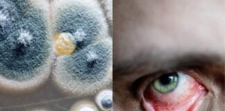 इस दवा से ठीक होंगे ब्लैक फंगस के मरीज, KGMU में चल रहा ट्रायल