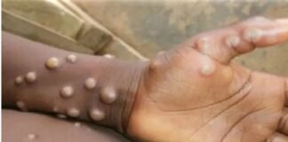 कोरोना संक्रमित के शरीर में मिला मंकीपॉक्स वायरस, संपर्क में आए लोगों की शुरू हुई जांच