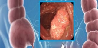 अल्सरेटिव कोलाइटिस का इलाज करेगी अब कोलेस्ट्रॉल घटाने वाली दवा: शोध