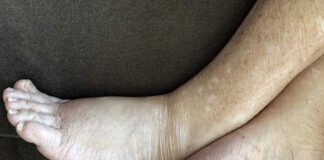 फाइलेरिया से मुक्ति के लिए बांटी गई दवाएं, मरीजों की तबियत बिगड़ी filaria