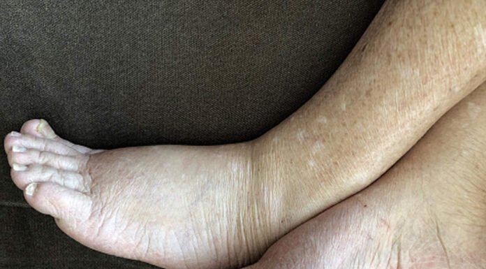 फाइलेरिया से मुक्ति के लिए बांटी गई दवाएं, मरीजों की तबियत बिगड़ी filaria