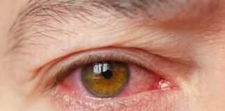 आंखों की रोशनी जाने के मामले में यूपी सरकार को नोटिस dry eye