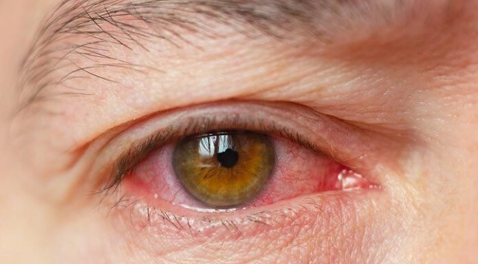 ड्राई आई की समस्या के लिए सन फार्मा का नया इलाज dry eye