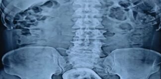 डॉक्टरों ने पेट से निकाला कांच का गिलास, आश्चर्यजनक किंतु सत्य कांच का गिलास