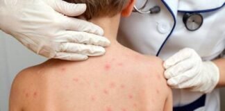 ओडिशा में तेजी से फैल रही संक्रामक बीमारी, 26 बच्चे पीड़ित बीमारी