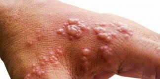 पटना में मंकीपॉक्स का पहला संदिग्ध मामला आया सामने मंकीपॉक्स