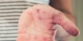 बढ़ने लगा टमाटर फ्लू, सामने आया 100 से ज्यादा मामला टमाटर फ्लू