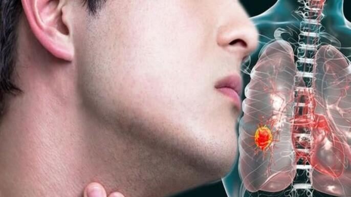 PGI रोहतक ने बनाया रिकॉर्ड , किया LUNG CANCER का पहला सफल ऑपरेशन