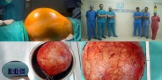 सफलता, डॉक्टरों ने निकाला फुटबॉल के आकार का किडनी ट्यूमर फुटबॉल के आकार का ट्यूमर