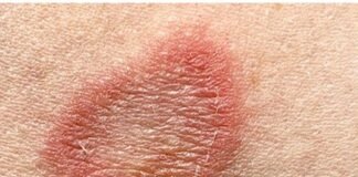 धीरे-धीरे भयावह होता जा रहा है दाद, स्टडी में चौंकाने वाला खुलासा