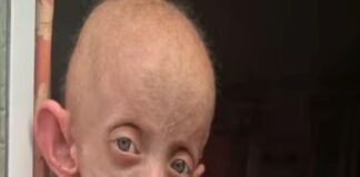 दुर्लभ बीमारियां एनपीआरडी में हुई शामिल