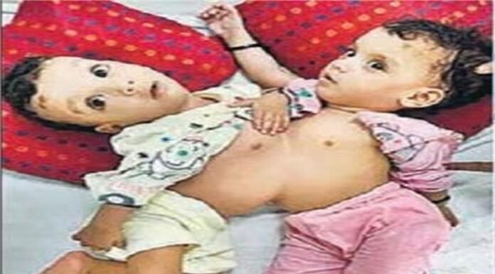 दिल्ली एम्स के डॉक्टरों ने छाती और पेट से जुड़ी जुड़वा बहनों को किया अलग