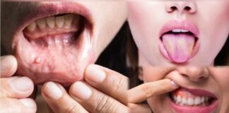 कैंसर पेशेंट के लिए अच्छी खबर, शुरुआत में ही लग जायेगा बीमारी का पता मुंह के कैंसर की सबसे बड़ी वजह धूम्रपान व तंबाकू सेवन