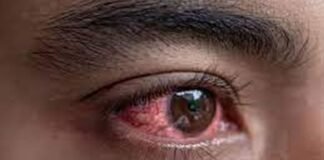 आई फ्लू में ना खायें दवाई होगा बड़ा नुकसान