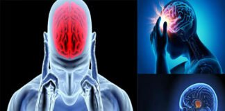 ब्लड प्रेशर की दवा बंद करने पर दोबारा पड़ रहा ब्रेन स्ट्रोक, रहें अलर्ट!