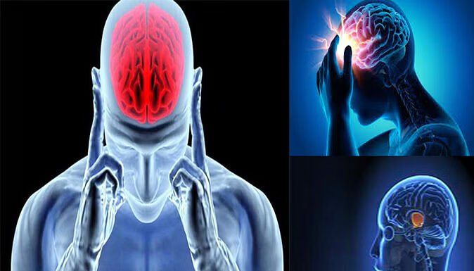 ब्लड प्रेशर की दवा बंद करने पर दोबारा पड़ रहा ब्रेन स्ट्रोक, रहें अलर्ट!