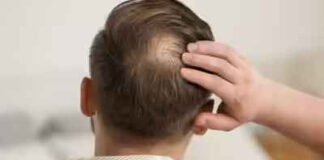 नई दवा से बाल प्राकृतिक रूप से फिर से उग सकेंगे