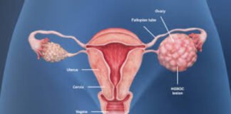 Ovarian Cancer के मरीजों के लिए नई दवा से बढ़ी उम्मीद